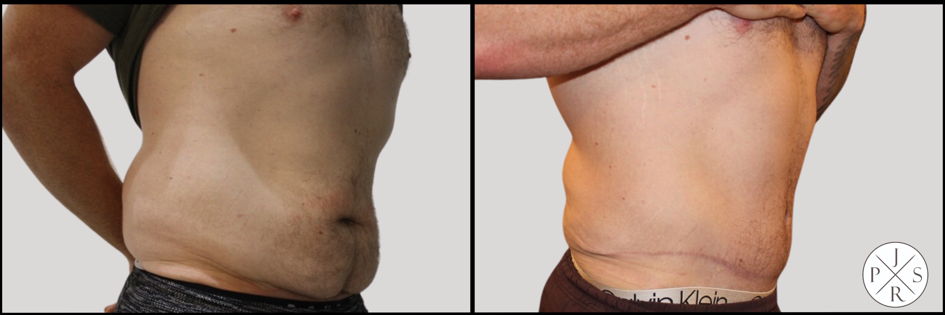 Abdominoplasty Before & After Image